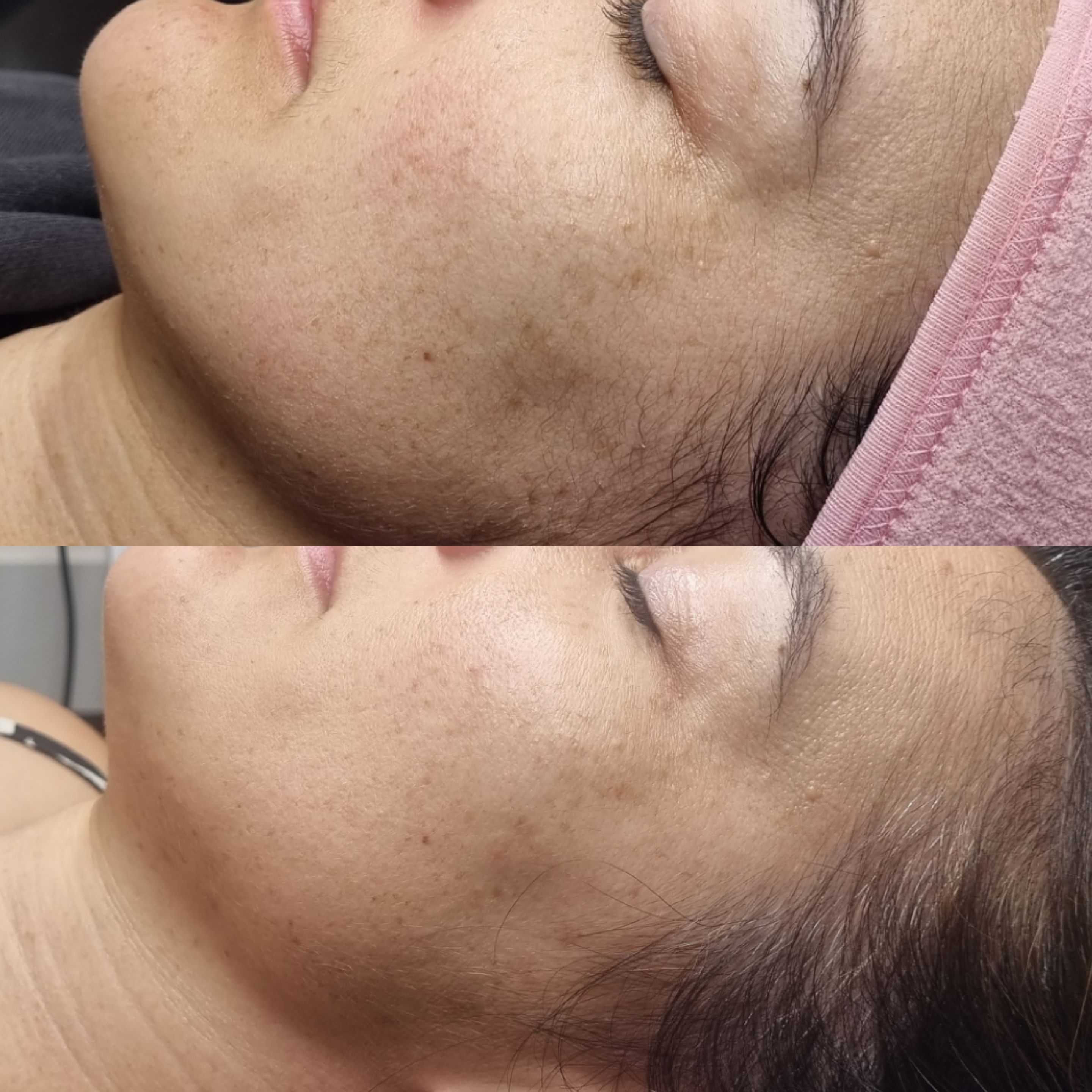 Skin treatment before and after