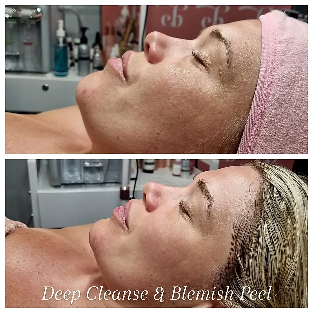 Deep cleanse and blemish peel before and after